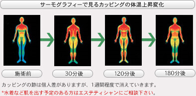 サーモグラフィーで見るカッピングの体温上昇変化